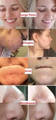 Before and after collage showing Large Pores, Pimples, Acne, and Blackheads results