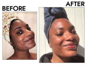 Before and after face results - Patience Moses