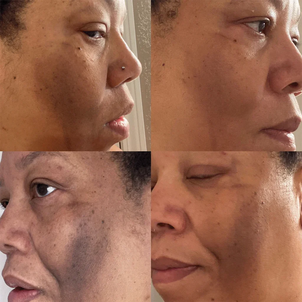 Before and after skin results