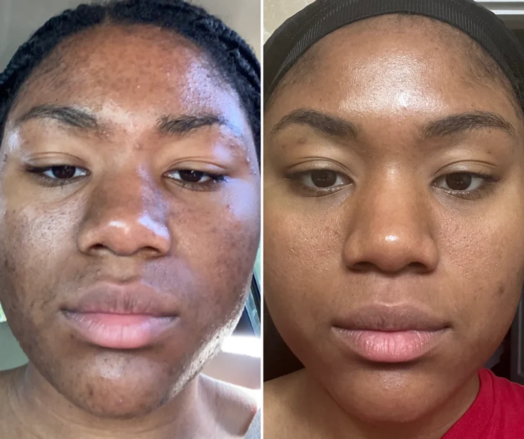 Before and after skincare results
